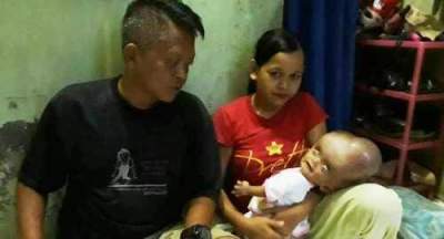 Penderita Hydrocephalus Zhafira saat digendong orang tuanya